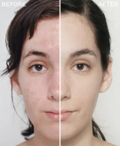 Eminence Clear Skin Results - Le Reve Organic Spa & Boutique -Serving Santa Barbara Montecito Summerland Carpinteria and Goleta 